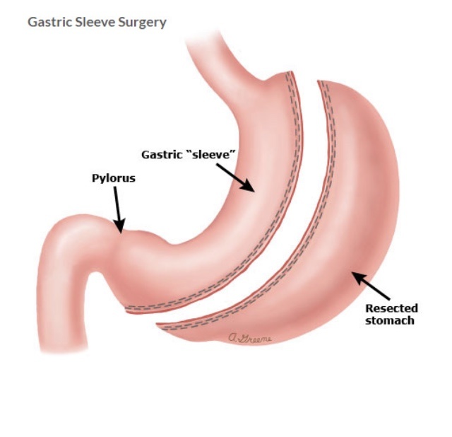 stomach sleeve bariatric surgery